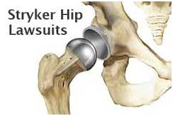 Stryker Medical Hip Implant Recall